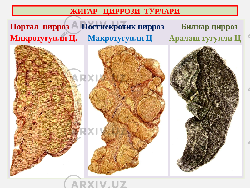 Портал цирроз Постнекротик цирроз Билиар цирроз Микротугунли Ц. Макротугунли Ц Аралаш тугунли ЦЖИГАР ЦИРРОЗИ ТУРЛАРИ 