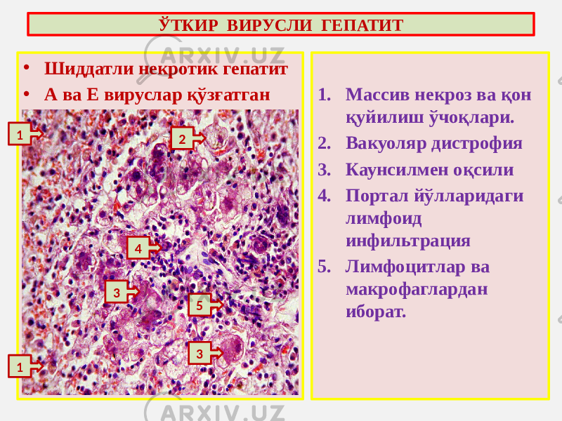 • Шиддатли некротик гепатит • А ва Е вируслар қўзғатган 1. Массив некроз ва қон қуйилиш ўчоқлари. 2. Вакуоляр дистрофия 3. Каунсилмен оқсили 4. Портал йўлларидаги лимфоид инфильтрация 5. Лимфоцитлар ва макрофаглардан иборат.ЎТКИР ВИРУСЛИ ГЕПАТИТ 1 1 2 3 4 5 3 