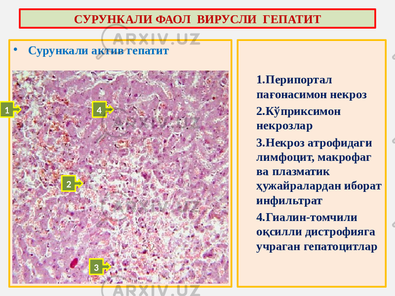 • Сурункали актив гепатит 1. Перипортал пағонасимон некроз 2. Кўприксимон некрозлар 3. Некроз атрофидаги лимфоцит, макрофаг ва плазматик ҳужайралардан иборат инфильтрат 4. Гиалин-томчили оқсилли дистрофияга учраган гепатоцитларСУРУНКАЛИ ФАОЛ ВИРУСЛИ ГЕПАТИТ 1 2 3 4 