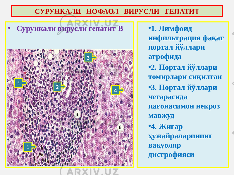 • Сурункали вирусли гепатит В • 1. Лимфоид инфильтрация фақат портал йўллари атрофида • 2. Портал йўллари томирлари сиқилган • 3. Портал йўллари чегарасида пағонасимон некроз мавжуд • 4. Жигар ҳужайраларининг вакуоляр дистрофиясиСУРУНКАЛИ НОФАОЛ ВИРУСЛИ ГЕПАТИТ 1 1 2 3 4 