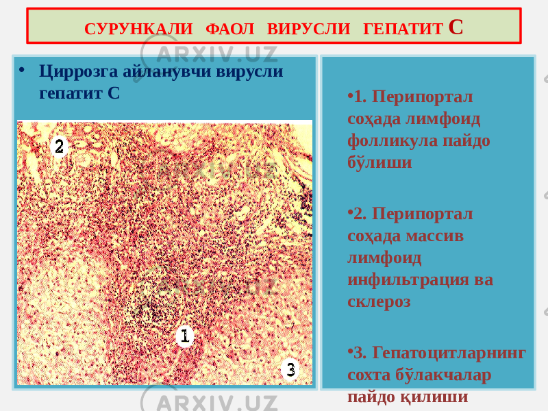 • Циррозга айланувчи вирусли гепатит С • 1. Перипортал соҳада лимфоид фолликула пайдо бўлиши • 2. Перипортал соҳада массив лимфоид инфильтрация ва склероз • 3. Гепатоцитларнинг сохта бўлакчалар пайдо қилишиСУРУНКАЛИ ФАОЛ ВИРУСЛИ ГЕПАТИТ С 