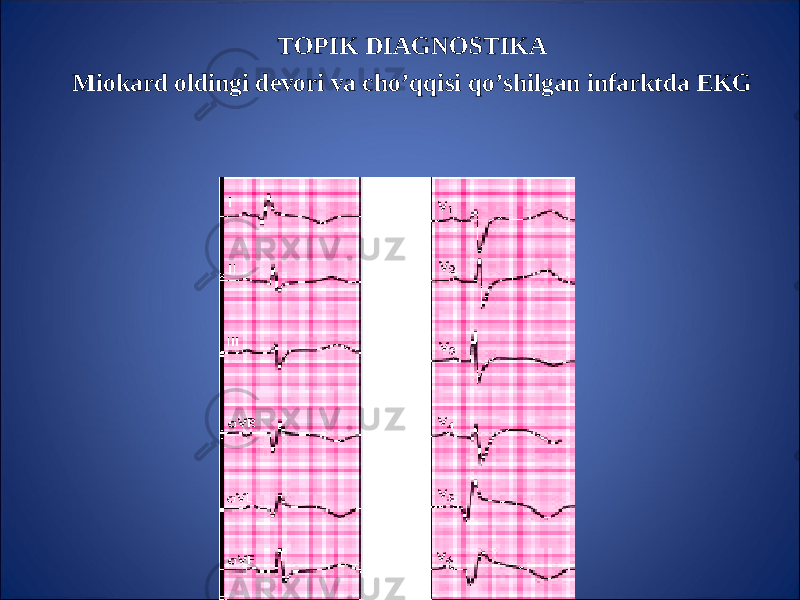 TOPIK DIAGNOSTIKA Miokard oldingi devori va ch o’qq isi qo’ shilgan infarktda EKG 