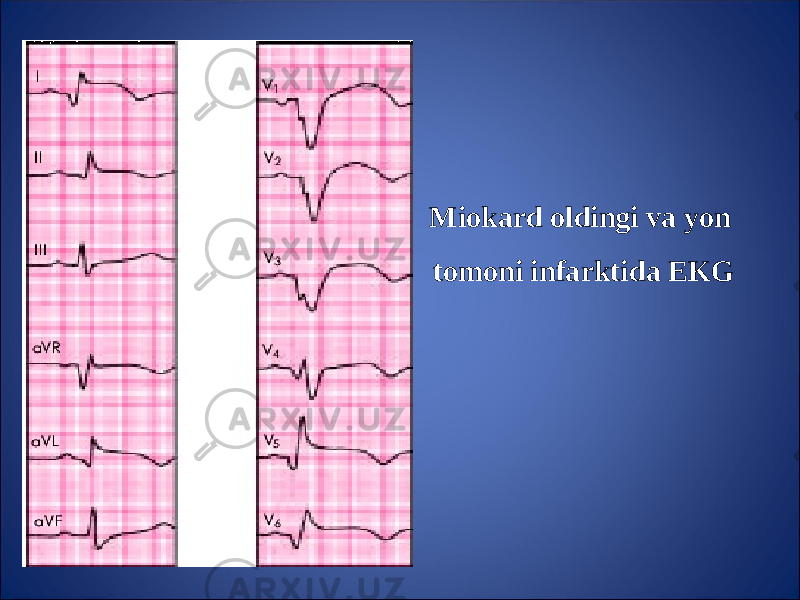 Miokard oldingi va yon tomoni infarktida EKG 