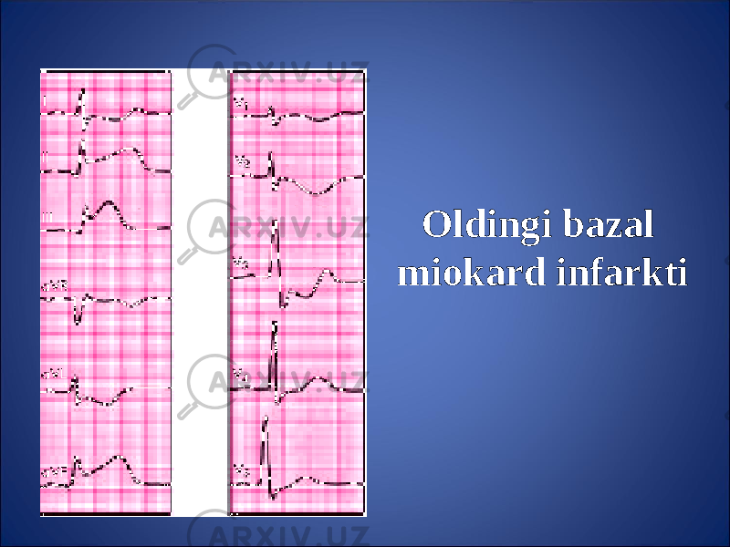 Oldingi bazal miokard infarkti 