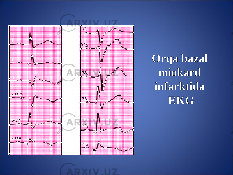 Or q a bazal miokard infarktida EKG 