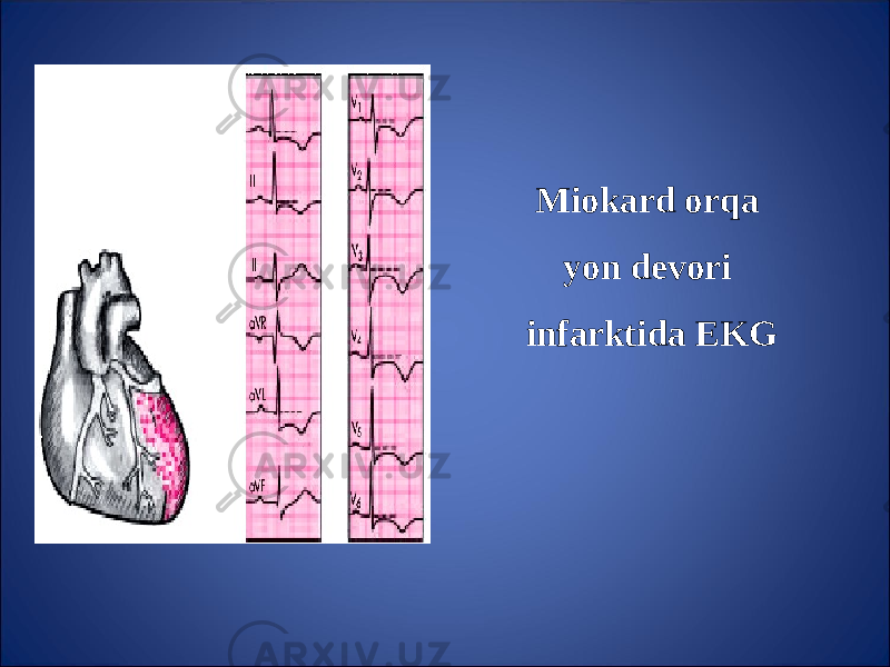 Miokard or q a yon devori infarktida EKG 