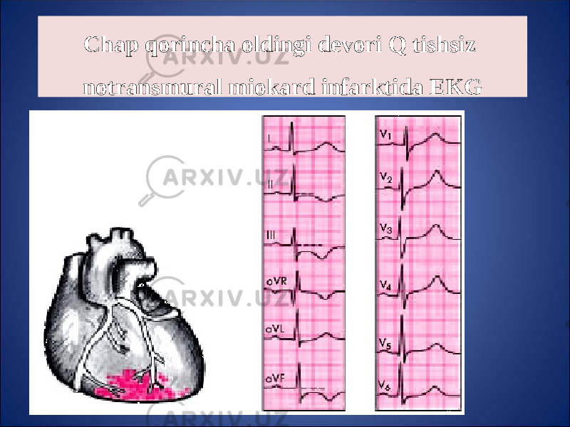 Chap q orincha oldingi devori Q tishsiz notransmural miokard infarktida EKG 