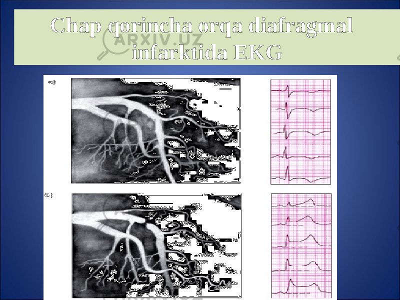 Chap q orincha or q a diafragmal infarktida EKG 