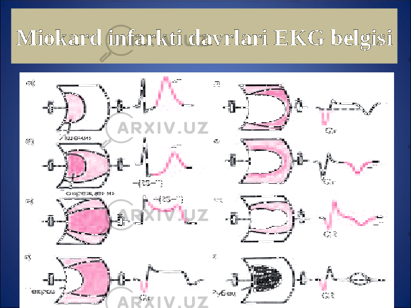 Miokard infarkti davrlari EKG belgisi 