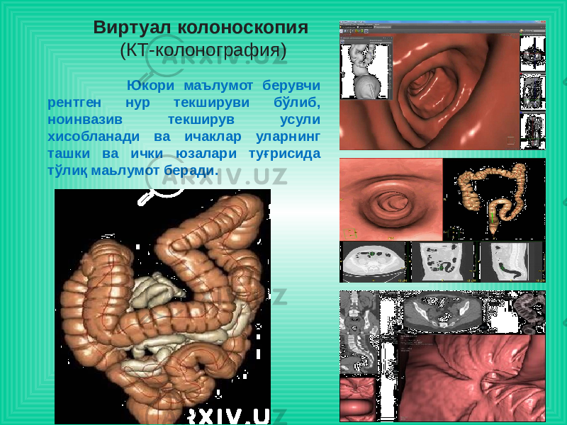 Виртуал колоноскопия   (КТ-колонография) Юкори маълумот берувчи рентген нур текшируви бўлиб, ноинвазив текширув усули хисобланади ва ичаклар уларнинг ташки ва ички юзалари туғрисида тўлиқ маьлумот беради. 