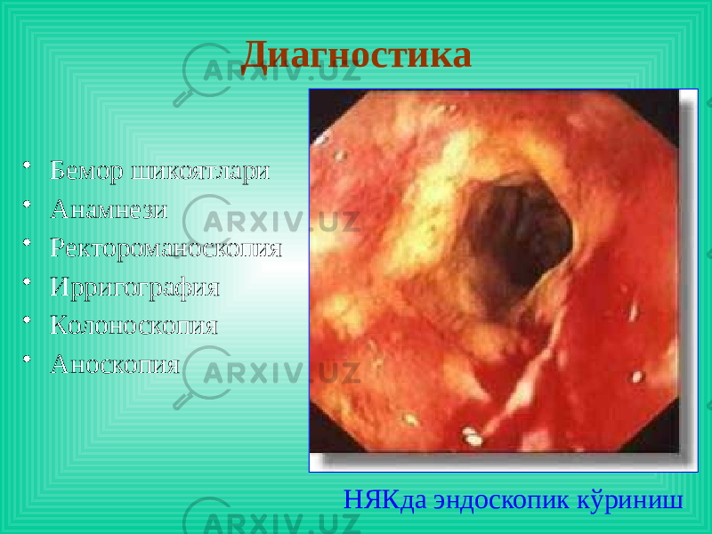 Диагностика • Бемор шикоятлари • Анамнези • Ректороманоскопия • Ирригография • Колоноскопия • Аноскопия НЯКда эндоскопик кўриниш 