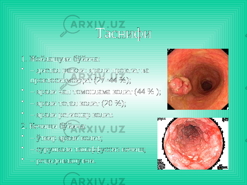 Таснифи 1. Жойлашуви бўйича: • – дистал шакли: ярали проктит ва проктосигмоидит (27–44 %); • – ярали чап томонлама колит (44 % ); • – ярали тотал колит (20 %); • – ярали регионар колит. 2. Кечиши бўйича: • – ўткир ярали колит; • – сурункали танаффуссиз кечиш; • – рецидивланувчи. 