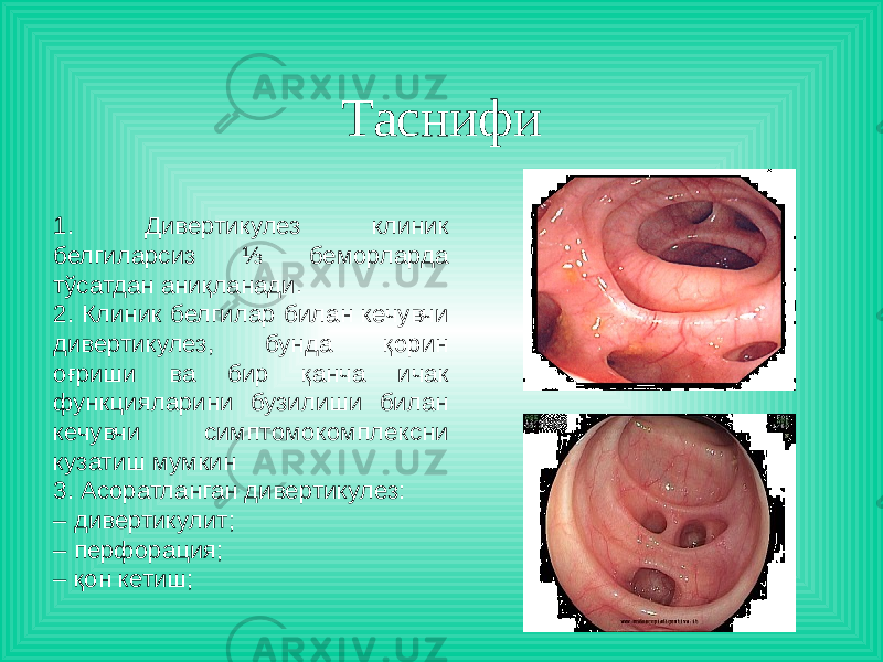 Таснифи 1. Дивертикулез клиник белгиларсиз ⅓ беморларда тўсатдан аниқланади. 2. Клиник белгилар билан кечувчи дивертикулез, бунда қорин оғриши ва бир қанча ичак функцияларини бузилиши билан кечувчи симптомокомплексни кузатиш мумкин 3. Асоратланган дивертикулез: – дивертикулит; – перфорация; – қон кетиш; 