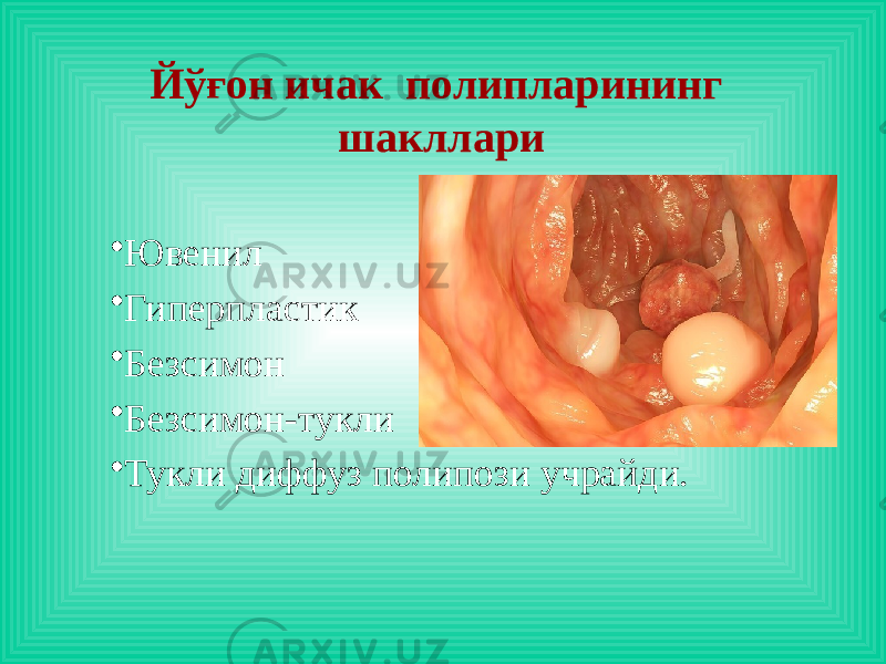 Йўғон ичак полипларининг шакллари • Ювенил • Гиперпластик • Безсимон • Безсимон-тукли • Тукли диффуз полипози учрайди. 