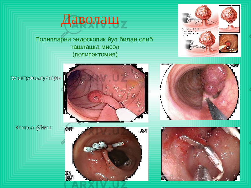Даволаш Полипларни эндоскопик йул билан олиб ташлашга мисол (полипэктомия) Электрокоагуляция Клипса қўйиш 