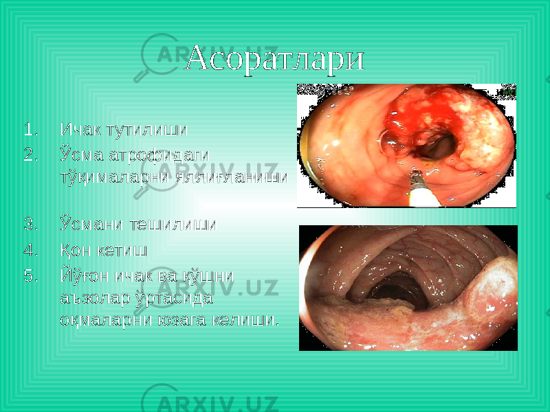 Асоратлари 1. Ичак тутилиши 2. Ўсма атрофидаги тўқималарни яллиғланиши 3. Ўсмани тешилиши 4. Қон кетиш 5. Йўғон ичак ва қўшни аъзолар ўртасида оқмаларни юзага келиши. 