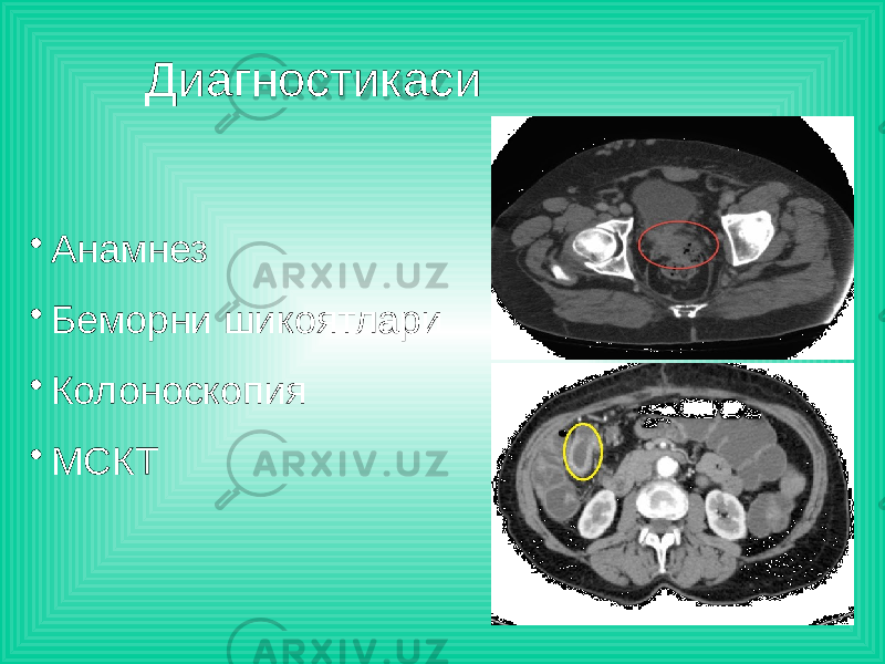 Диагностикаси • Анамнез • Беморни шикоятлари • Колоноскопия • МСКТ 