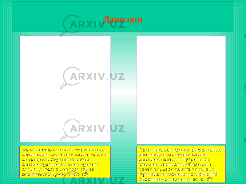 Даволаш Орка чикарув тешиги атрезиясида ораликдан узунасига кесма оркали операция 1.Узунасига кесма оркали турги ичак епик чунтаги очилади Кесма линияси (а) ва ажратилган Тў²ри ичак (б) Орка чикарув тешиги атрезиясида ораликдан узунасига кесма оркали операция Тў²ри ичак шиллик кавти очилиб шиллик кават кирраси терига тикилади. Кундаланг кесимда чоклар(а) ва операциядан кецинги холат(б) 