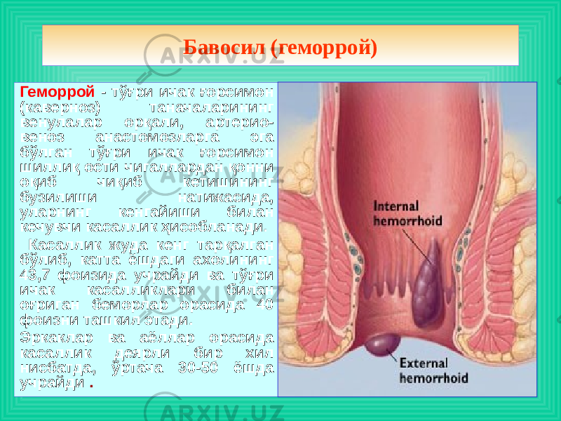 Геморрой - тўғри ичак ғорсимон (каверноз) таначаларининг венулалар орқали, артерио- веноз анастомозларга эга бўлган тўғри ичак ғорсимон шиллиқ ости чигаллардан қонни оқиб чиқиб кетишининг бузилиши натижасида, уларнинг кенгайиши билан кечувчи касаллик ҳисобланади. Касаллик жуда кенг тарқалган бўлиб, катта ёшдаги ахолининг 43,7 фоизида учрайди ва тўғри ичак касалликлари билан оғриган беморлар орасида 40 фоизни ташкил этади. Эркаклар ва аёллар орасида касаллик деярли бир хил нисбатда, ўртача 30-50 ёшда учрайди . Бавосил (геморрой) 