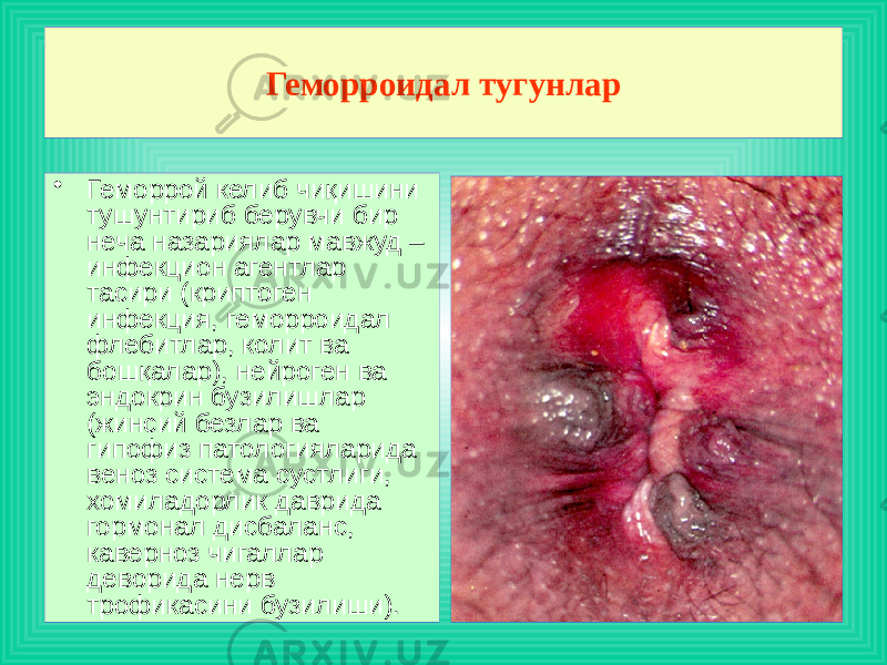 Геморроидал тугунлар • Геморрой келиб чиқишини тушунтириб берувчи бир неча назариялар мавжуд – инфекцион агентлар тасири (криптоген инфекция, геморроидал флебитлар, колит ва бошқалар), нейроген ва эндокрин бузилишлар (жинсий безлар ва гипофиз патологияларида веноз система сустлиги, хомиладорлик даврида гормонал дисбаланс, каверноз чигаллар деворида нерв трофикасини бузилиши). 