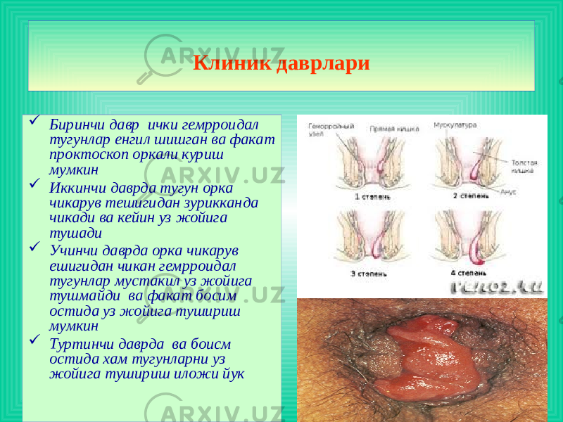  Биринчи давр ички гемрроидал тугунлар енгил шишган ва факат проктоскоп оркали куриш мумкин  Иккинчи даврда тугун орка чикарув тешигидан зурикканда чикади ва кейин уз жойига тушади  Учинчи даврда орка чикарув ешигидан чикан гемрроидал тугунлар мустакил уз жойига тушмайди ва факат босим остида уз жойига тушириш мумкин  Туртинчи даврда ва боисм остида хам тугунларни уз жойига тушириш иложи йук Клиник даврлари 