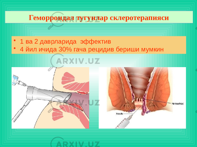 Геморроидал тугунлар склеротерапияси • 1 ва 2 даврларида эффектив • 4 йил ичида 30% гача рецидив бериши мумкин 