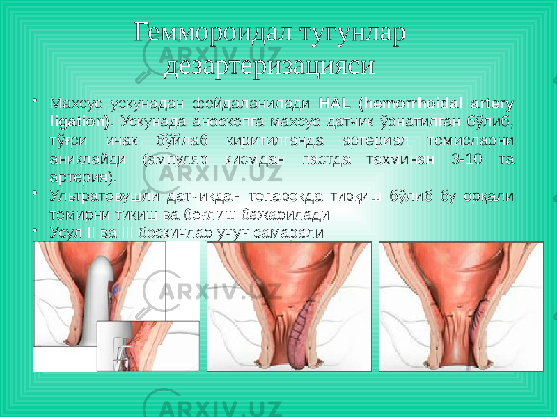 Геммороидал тугунлар дезартеризацияси  • Махсус ускунадан фойдаланилади HAL (hemorrhoidal artery ligation) . Ускунада аноскопга махсус датчик ўрнатилган бўлиб, тўғри ичак бўйлаб киритилганда артериал томирларни аниқлайди (ампуляр қисмдан пастда тахминан 3-10 та артерия). • Ультратовушли датчикдан тепарокда тирқиш бўлиб бу орқали томирни тикиш ва боғлиш бажарилади. • Усул II ва III босқичлар учун самарали. 