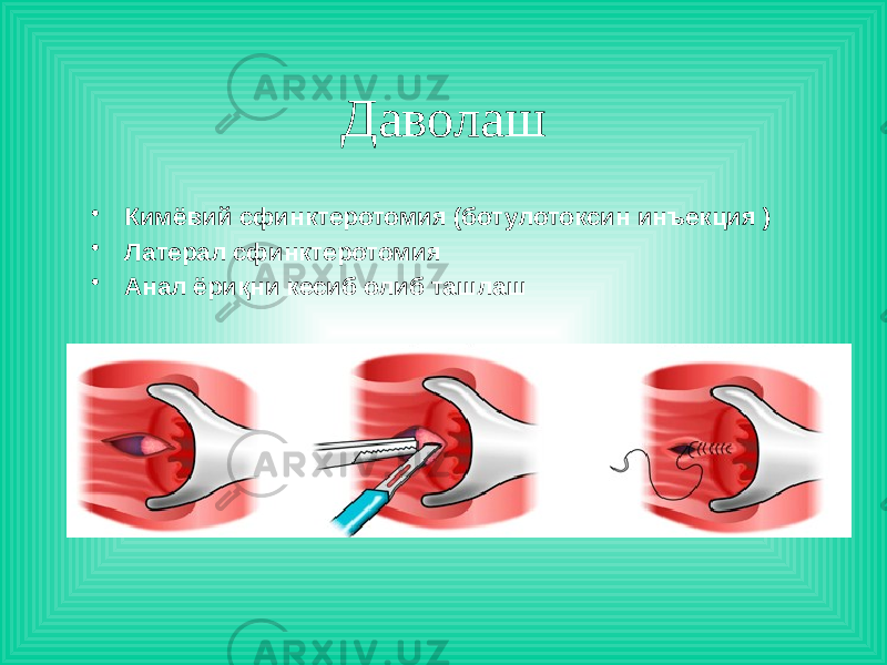 Даволаш • Кимёвий сфинктеротомия (ботулотоксин инъекция ) • Латерал сфинктеротомия • Анал ёриқни кесиб олиб ташлаш 