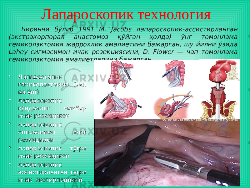 Лапароскопик технология • Лапароскопик гемиколэктомия (чап ва ўнг) • лапароскопик кўндаланг чамбар ичак резекцияси • лапароскопик сигмасимон ичак резекцияси • лапароскопик тўғри ичак резекцияси • лапароскопик ассистирланган тўғри ичак экстирпацияси Биринчи бўлиб 1991 М. Jacobs лапароскопик-ассистирланган (экстракорпорал анастомоз қўйган ҳолда) ўнг томонлама гемиколэктомия жаррохлик амалиётини бажарган, шу йилни ўзида Lahey сигмасимон ичак резекциясини, D. Flower — чап томонлама гемиколэктомия амалиётларини бажарган. 