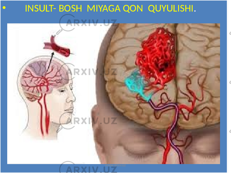 • INSULT- BOSH MIYAGA QON QUYULISHI . www.arxiv.uz01 0A 34 02 