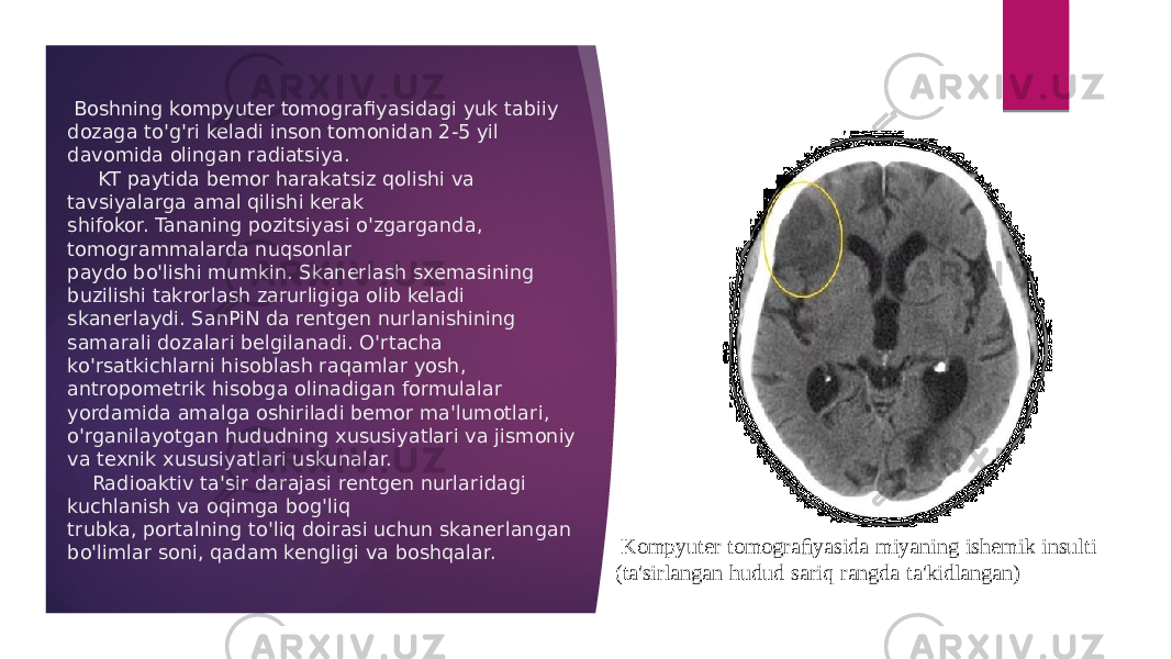  Boshning kompyuter tomografi yasidagi yuk tabiiy dozaga to&#39;g&#39;ri keladi inson tomonidan 2-5 yil davomida olingan radiatsiya. KT paytida bemor harakatsiz qolishi va tavsiyalarga amal qilishi kerak shifokor. Tananing pozitsiyasi o&#39;zgarganda, tomogrammalarda nuqsonlar paydo bo&#39;lishi mumkin. Skanerlash sxemasining buzilishi takrorlash zarurligiga olib keladi skanerlaydi. SanPiN da rentgen nurlanishining samarali dozalari belgilanadi. O&#39;rtacha ko&#39;rsatkichlarni hisoblash raqamlar yosh, antropometrik hisobga olinadigan formulalar yordamida amalga oshiriladi bemor ma&#39;lumotlari, o&#39;rganilayotgan hududning xususiyatlari va jismoniy va texnik xususiyatlari uskunalar. Radioaktiv ta&#39;sir darajasi rentgen nurlaridagi kuchlanish va oqimga bog&#39;liq trubka, portalning to&#39;liq doirasi uchun skanerlangan bo&#39;limlar soni, qadam kengligi va boshqalar. Kompyuter tomograﬁyasida miyaning ishemik insulti (ta&#39;sirlangan hudud sariq rangda ta&#39;kidlangan) 