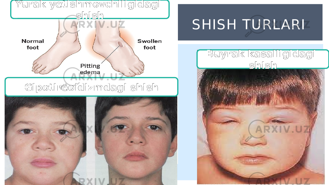 SHISH TU RL ARIYurak yetishmovchiligidagi shish Buyrak kasalligidagi shish Gipotireoidizmdagi shish 