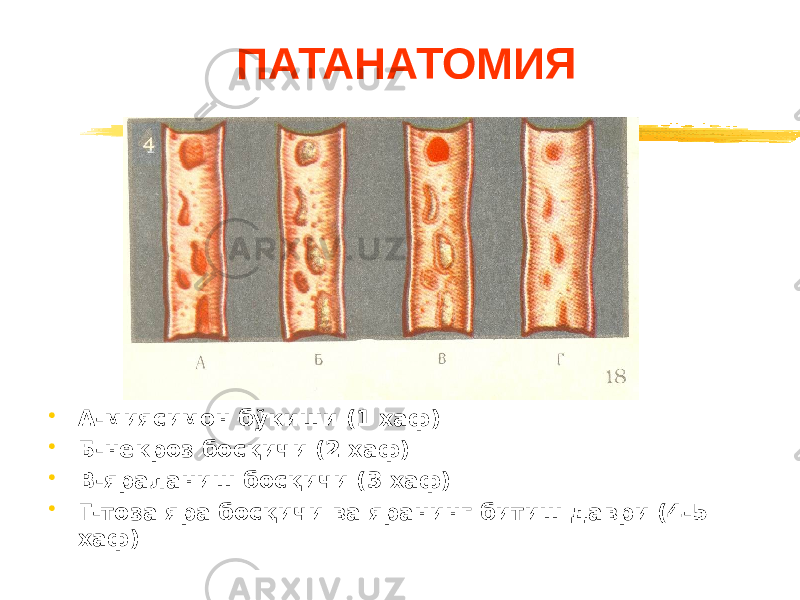 ПАТАНАТОМИЯ • А-миясимон бўкиши (1 хаф) • Б-некроз босқичи (2 хаф) • В-яраланиш босқичи (3 хаф) • Г-тоза яра босқичи ва яранинг битиш даври (4-5 хаф) 