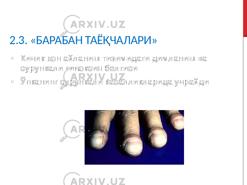 2.3. «БАРАБАН ТАЁҚЧАЛАРИ» • Кичик қон айланиш тизимидаги димланиш ва сурункали гипоксия белгиси • Ўпканинг сурункали касалликларида учрайди 