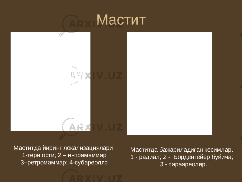 Мастит Маститда йиринг локализациялари. 1-тери ости; 2 – интрамаммар 3–ретромаммар; 4-субареоляр Маститда бажариладиган кесимлар. 1 - радиал; 2 - Борденгейер буйича; 3 - параареоляр. 