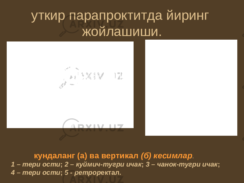 уткир парапроктитда йиринг жойлашиши. кундаланг (а) ва вертикал (б) кесимлар . 1 – тери ости ; 2 – куймич-тугри ичак ; 3 – чанок-тугри ичак ; 4 – тери ости ; 5 - ретрор ектал. 