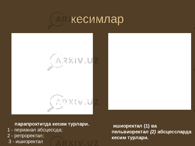 кесимлар парапроктитда кесим турлари. 1 - перианал абсцессда; 2 - ретроректал; 3 - ишиоректал ишиоректал (1) ва пельвиоректал (2) абсцессларда кесим турлари. 