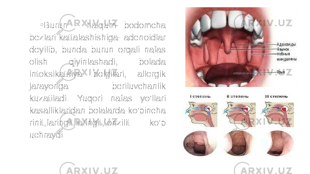 • Burun - halqum bodomcha bezlari kattalashishiga- adenoidlar deyilib, bunda burun orqali nafas olish qiyinlashadi, bolada intoksikatsiya belgilari, allergik jarayonga beriluvchanlik kuzatiladi. Yuqori nafas yo’llari kasalliklaridan bolalarda ko’pincha rinit,faringit,laringit,tonzilit ko’p uchraydi. 