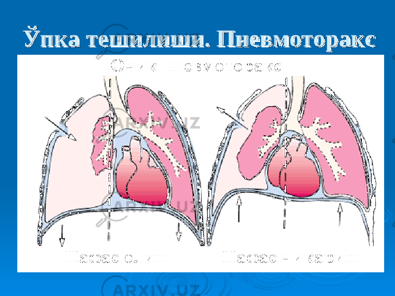 Ўпка тешилиши. ПневмотораксЎпка тешилиши. Пневмоторакс 