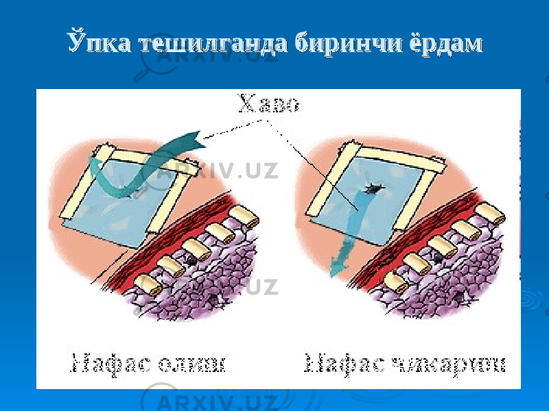 Ўпка тешилганда биринчи ёрдамЎпка тешилганда биринчи ёрдам 