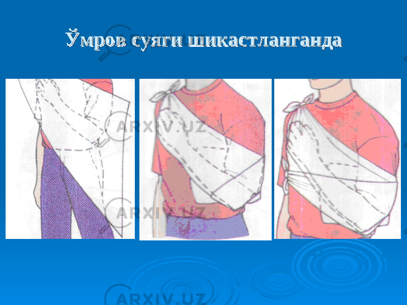 Ўмров суяги Ўмров суяги шикастлангандашикастланганда 