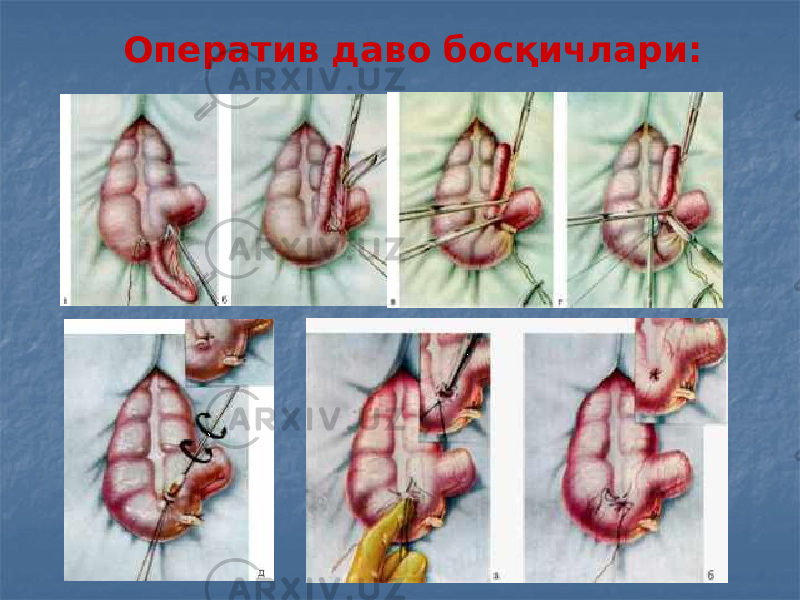 Оператив даво босқичлари: 