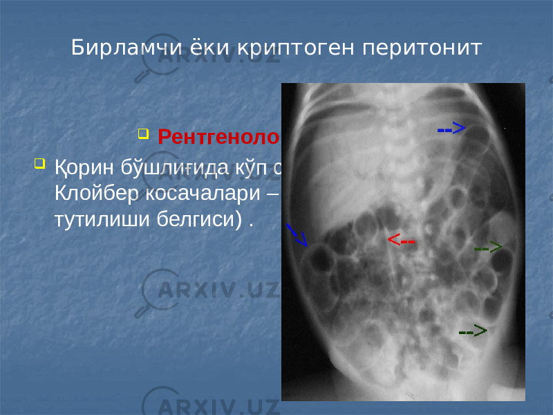 Бирламчи ёки криптоген перитонит  Рентгенологик тешириш  Қорин бўшлиғида кўп сонли, бир хил ўлчамли Клойбер косачалари – (паралитик ичак тутилиши белгиси) . 