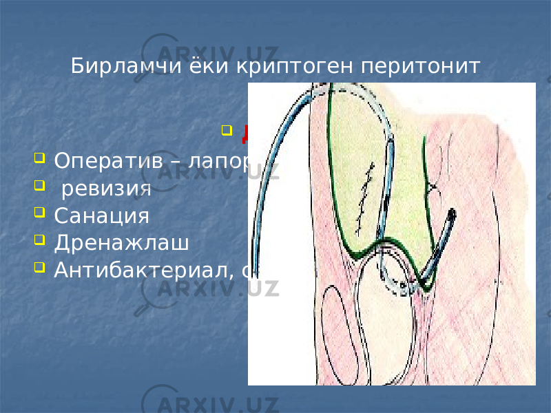 Бирламчи ёки криптоген перитонит  Давоси  Оператив – лапоратомия  ревизия  Санация  Дренажлаш  Антибактериал, симптоматик терапия 