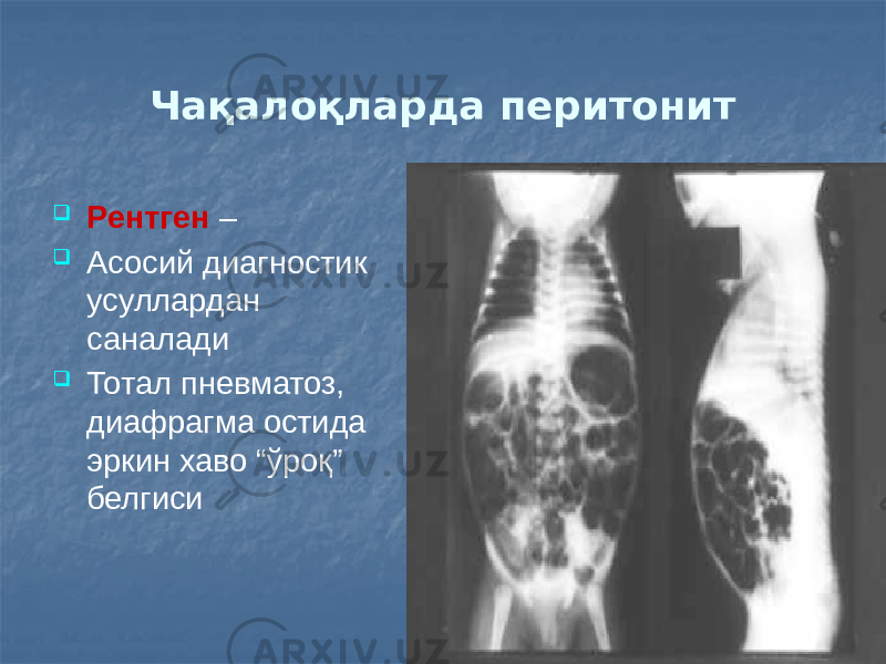 Чақалоқларда перитонит  Рентген –  Асосий диагностик усуллардан саналади  Тотал пневматоз, диафрагма остида эркин хаво “ўроқ” белгиси 