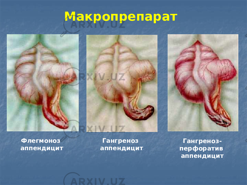 Флегмоноз аппендицит Гангреноз аппендицит Гангреноз- перфоратив аппендицит Макропрепарат 