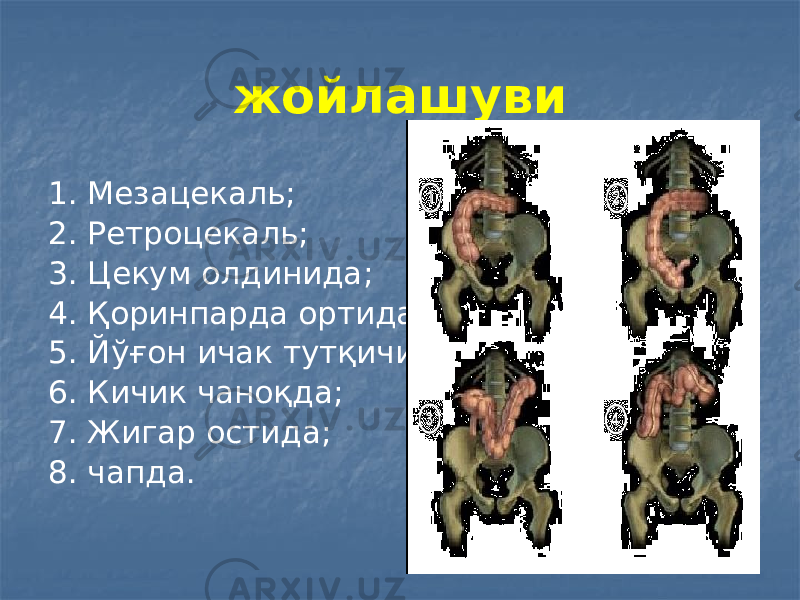 жойлашуви 1. Мезацекаль; 2. Ретроцекаль; 3. Цекум олдинида; 4. Қоринпарда ортида; 5. Йўғон ичак тутқичида; 6. Кичик чаноқда; 7. Жигар остида; 8. чапда. 