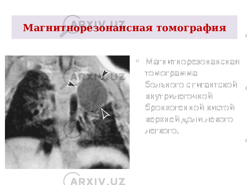 Магнитнорезонансная томография • Магнитнорезонансная томограмма больного с гигантской внутрилегочной бронхогенной кистой верхней доли левого легкого. 