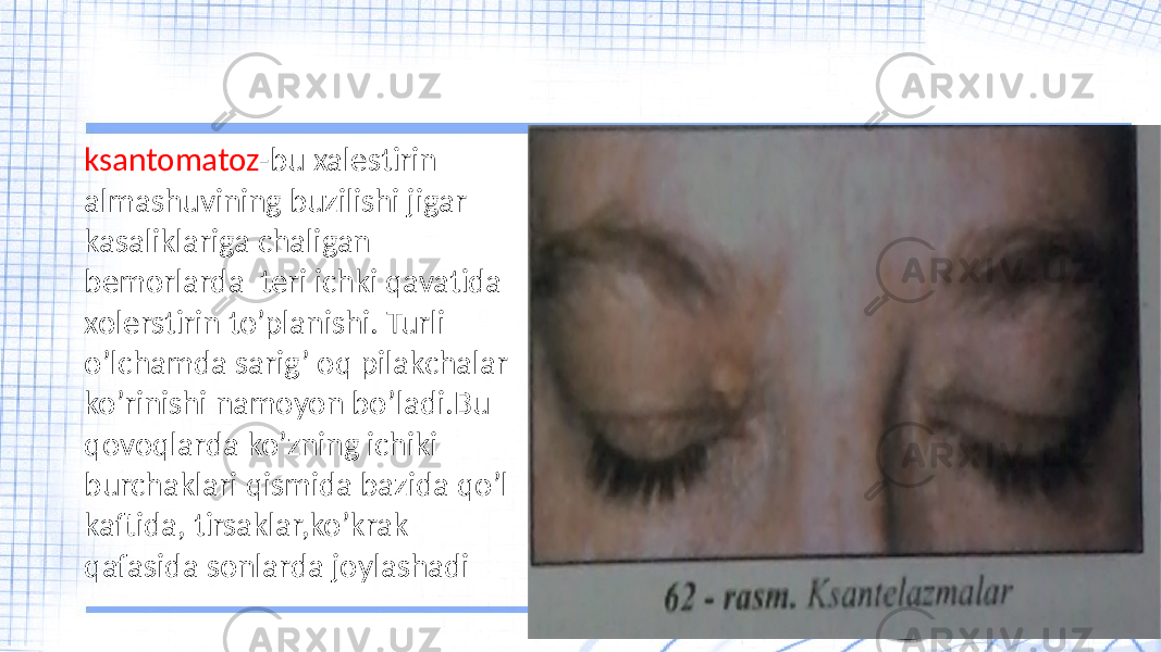 ksantomatoz -bu xalestirin almashuvining buzilishi jigar kasaliklariga chaligan bemorlarda teri ichki qavatida xolerstirin to’planishi. Turli o’lchamda sarig’ oq pilakchalar ko’rinishi namoyon bo’ladi.Bu qovoqlarda ko’zning ichiki burchaklari qismida bazida qo’l kaftida, tirsaklar,ko’krak qafasida sonlarda joylashadi 