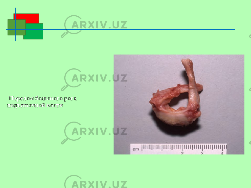  Перелом большого рога подъязычной кости 